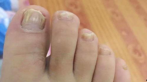 去灰指甲视频,轻松恢复健康指甲的秘诀揭秘