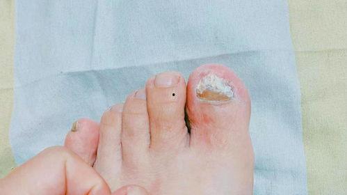 去灰指甲视频,轻松恢复健康指甲的秘诀揭秘
