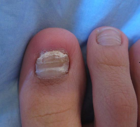 去灰指甲视频,轻松恢复健康指甲的秘诀揭秘